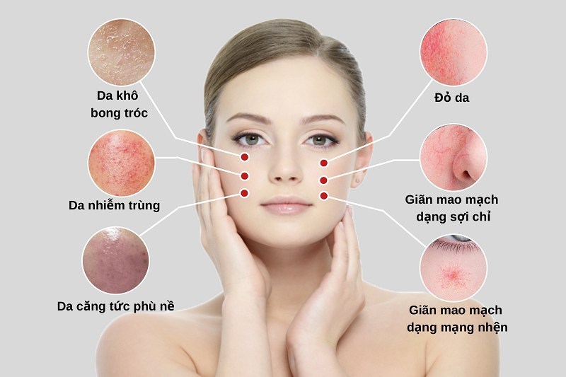 Kem phục hồi kích ứng da Couperose