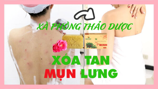 Xà phòng thảo dược trị mụn