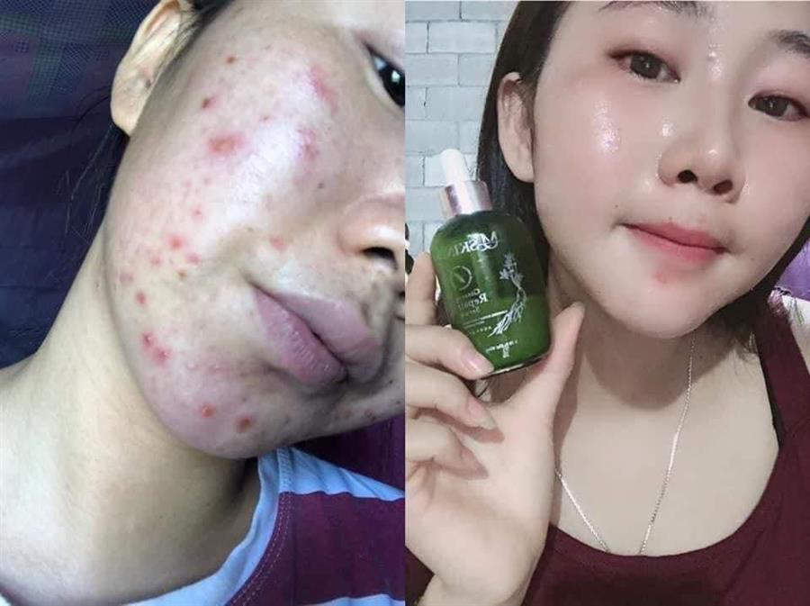 Tái tạo da nhân sâm MQ SKIN